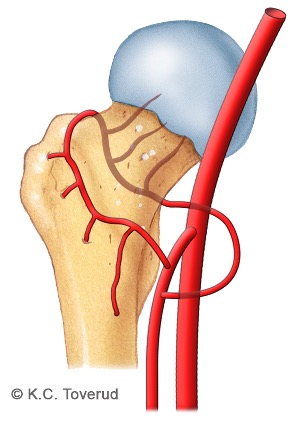 Innkilt fractura colli femoris, medial type