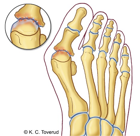 Hallux valgus