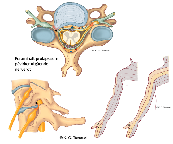Radicular pain from a nerve root