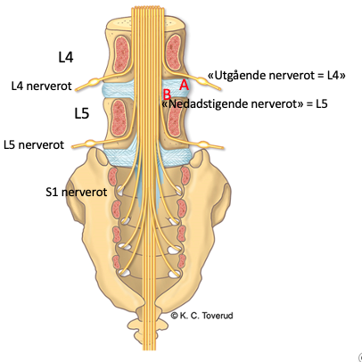 Posterolateral (paracentral) herniation is most common