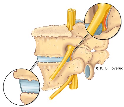 Lateral spinal stenosis (lateral recess stenosis)