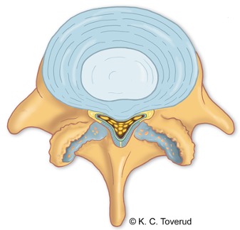 Central spinal stenosis