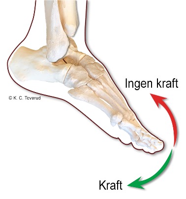 Foot drop, several nerve roots affected