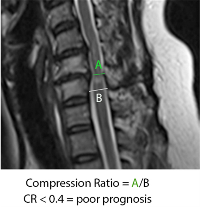 Cervical myelopathy