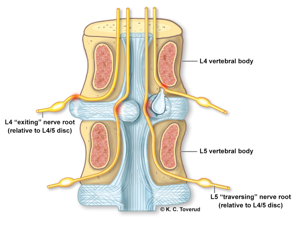 Location of lumbar disc herniation in the spinal canal