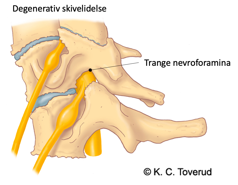 Nakke, degenerativ nakke, Cervical Spondylose
